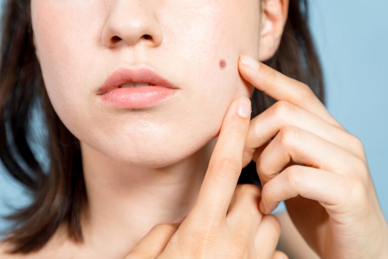Acne, risolvila a tavola senza farmaci