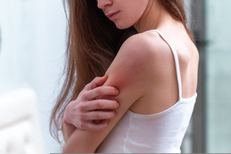 Psoriasi guida definitiva