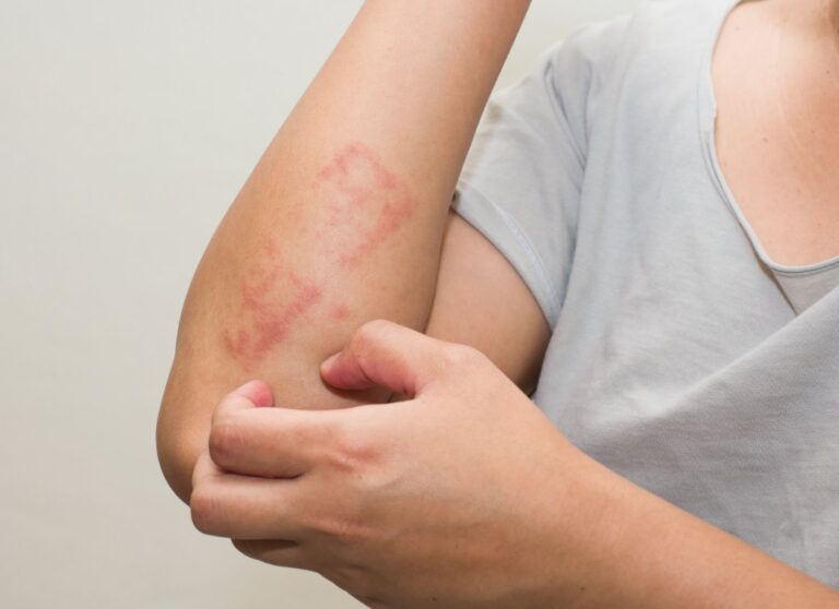 Dermatite atopica, cos'è e come trattarne i sintomi