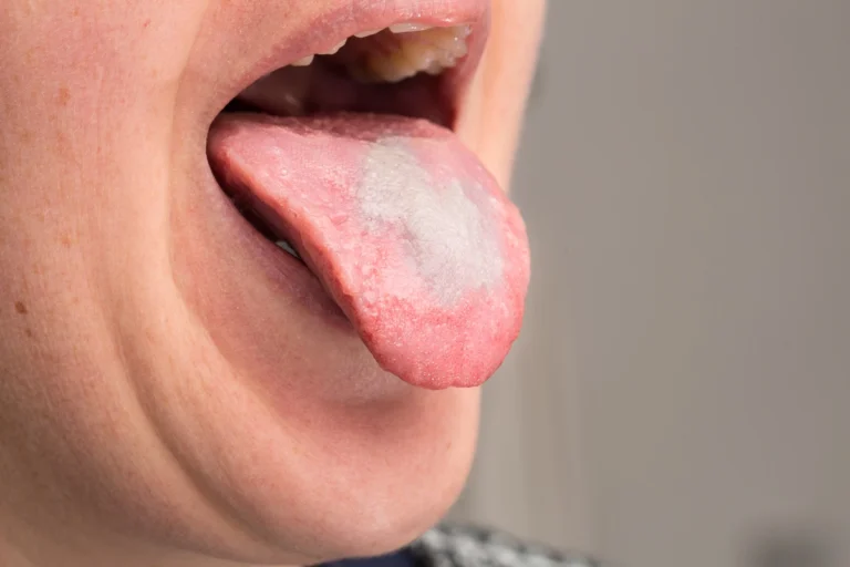 Candida: le 3 cure naturali