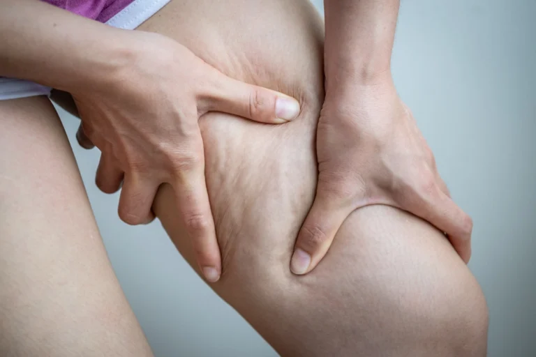 Le 5 cause della cellulite