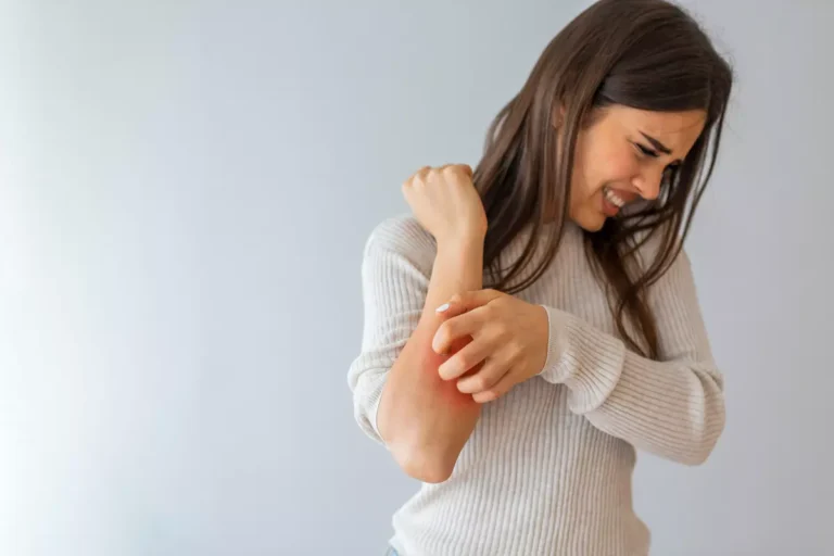 Dermatite seborroica: cos’è, sintomi e come trattarla naturalmente